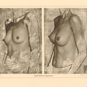 Mammary Augmentation by Jonathan Yeo